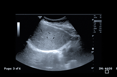 Liver Shear Elastography